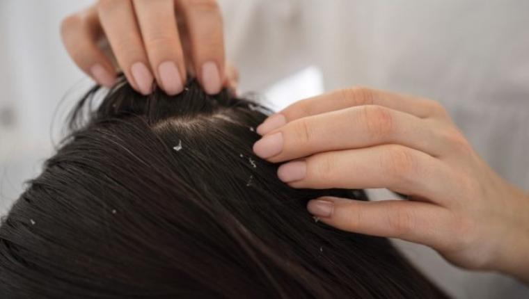 Beat Annoying Winter Hair Fall: 8 Powerful Tips for a Healthier, Stronger Scalp