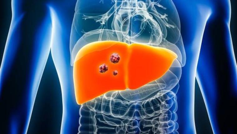 Historic Medical First: UAE Pioneers Liver Cancer Treatment Offering Hope to Patients