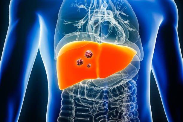 Historic Medical First: UAE Pioneers Liver Cancer Treatment Offering Hope to Patients